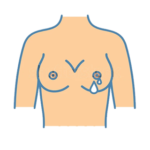 Abnormal Production Of Breast Milk (Galactorrhea)